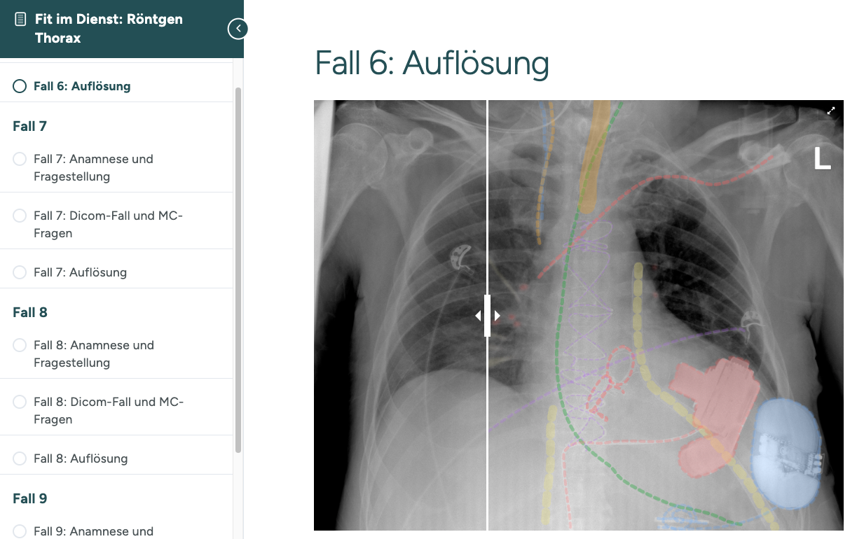 Fit im Dienst: Röntgen-Thorax mit Befund-Slider
